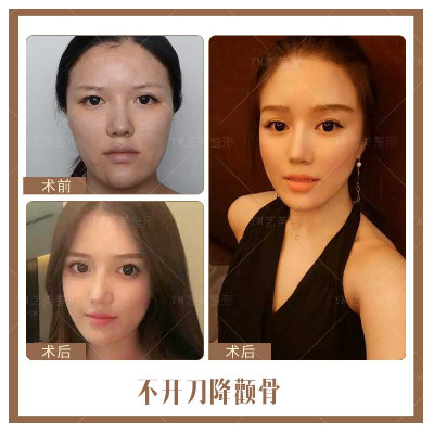 颧骨磨骨会导致哪些不好的情况发生