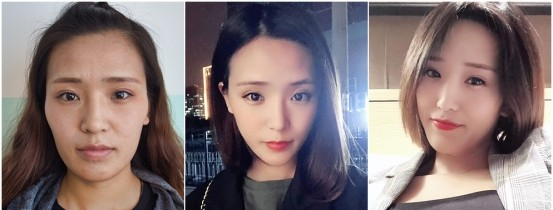艺美巩敏面部精雕,巩敏面部填充,艺美整形巩敏
