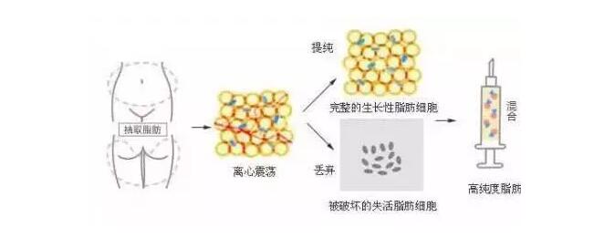 自体脂肪填充面部