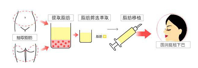 自体脂肪丰下巴