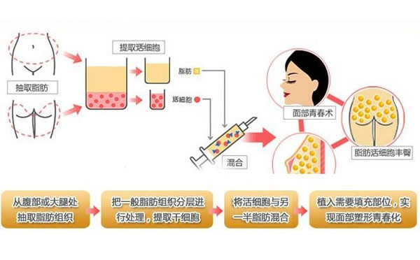 自体脂肪提取过程