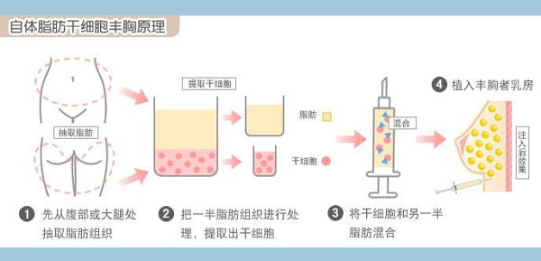 自体脂肪丰胸过程